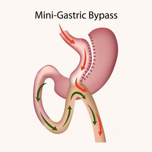 Mini Gastric Bypass Surgery