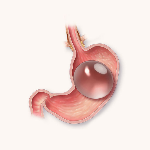 Intragastric Balloon Surgery in Ahmedabad
