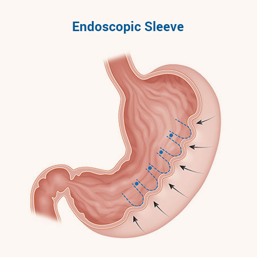 Endoscopic Bariatric Surgery in Ahmedabad
