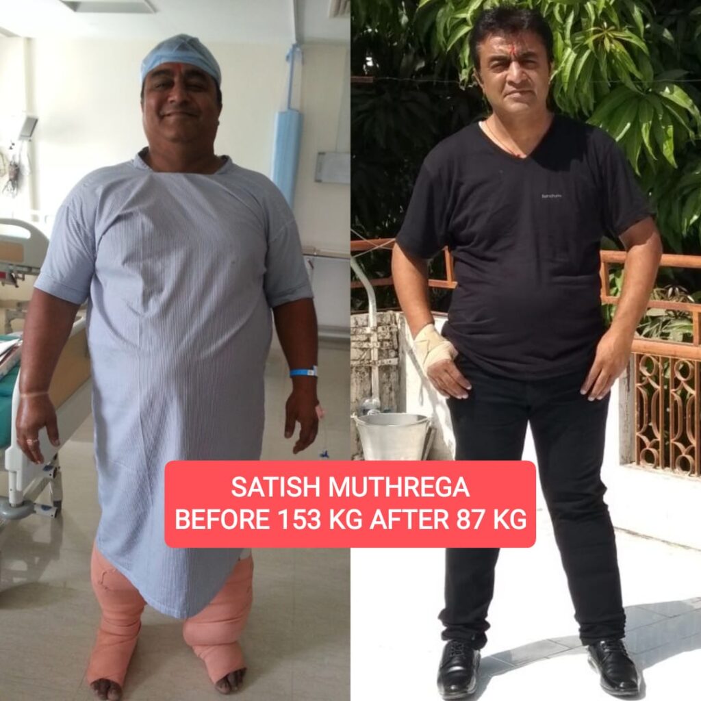 Before and After Mr. Satish Muthrega