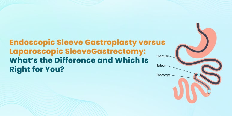 Endoscopic Sleeve Gastroplasty Vs Laparoscopic Sleeve Gastrectomy Which Is Right For You Esg 0618