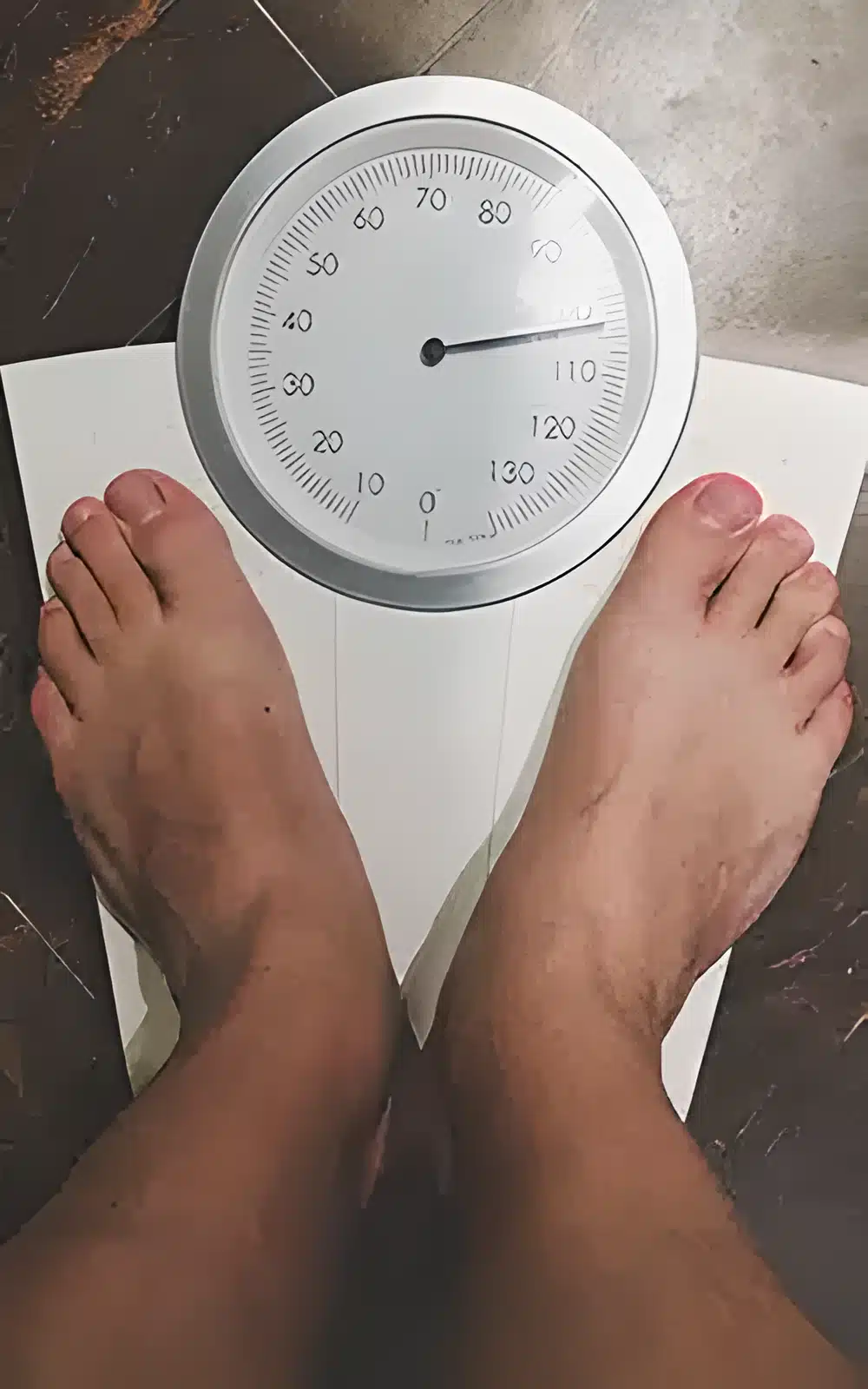 Causes of Obesity in Ahmedabad