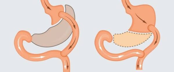 Reversing Type 2 Diabetes: How Metabolic Surgery Heals Your Body From the Inside Out