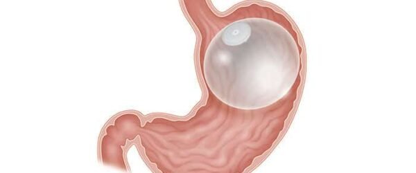 Non-Surgical Weight Loss: Is an Endoscopic Gastric Balloon Right for You?