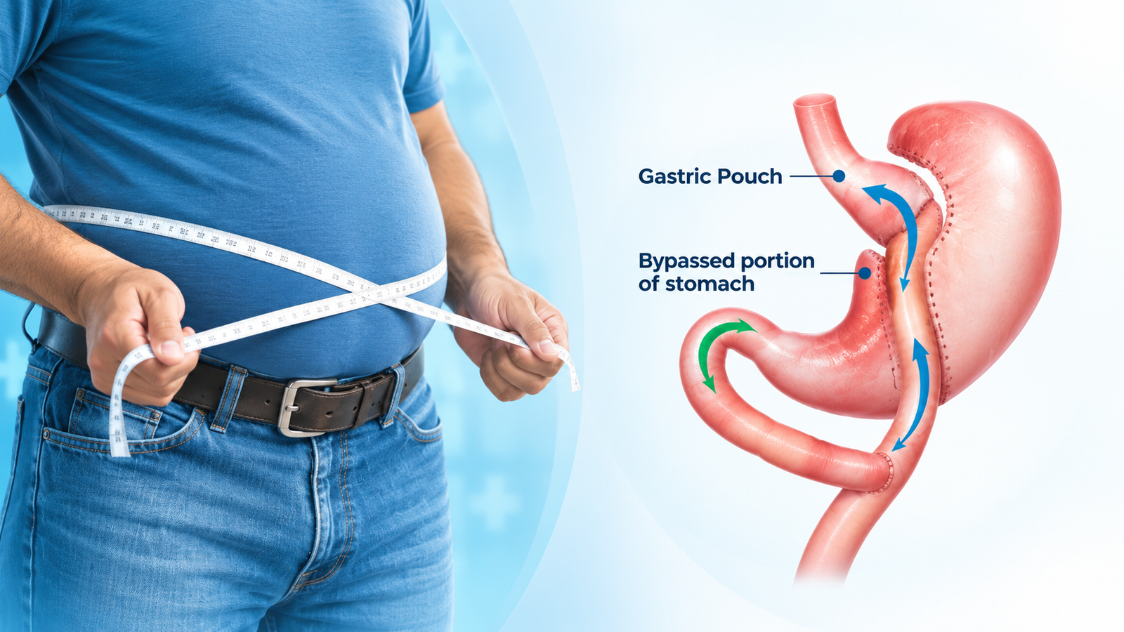 Gastric-Bypass-Surgery-11