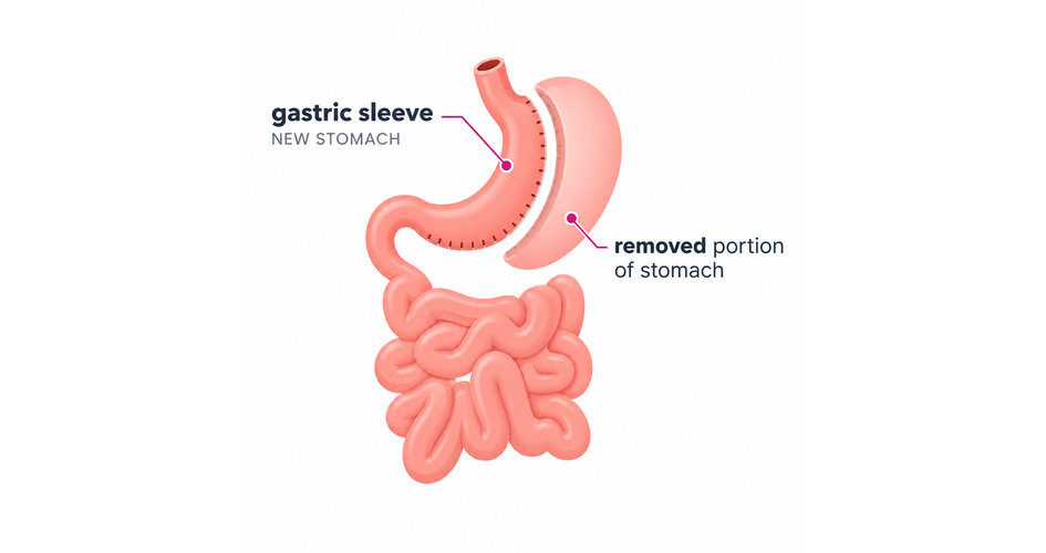 Gastric-Sleeve-945x500
